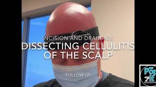 Dissecting cellulitis of the scalp ID of pus pockets Drainage of purulent discharge MrPopZit [upl. by Madelyn401]