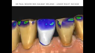 Emax central Incisor crown  Preperation Design Stain and Glaze with VisionButler Comparison [upl. by Narbig]