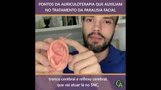 Auriculoterapia na paralisia facial [upl. by Norda656]