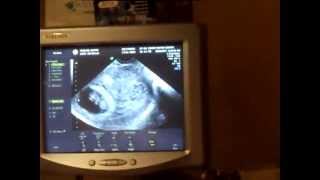 Ultrasound surprise Its Twins [upl. by Darken]