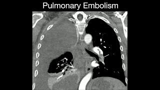 Pulmonary Embolism [upl. by Seftton]