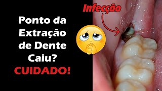 Ponto do Dente Soltou Após Extração  Descubra o que Fazer Para Evitar Infecção  Alveolite [upl. by Chill]