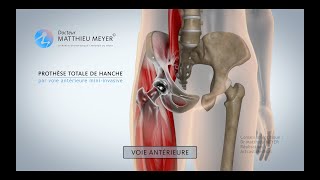 PROTHÈSE TOTALE DE HANCHE PAR VOIE ANTÉRIEURE MINIINVASIVE  DR MATTHIEU MEYER [upl. by Patnode191]