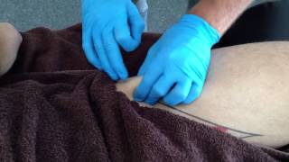 Dry Needling Rectus Femoris [upl. by Dnalevets]