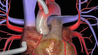 Coronaire bypass CABG [upl. by Ylrae]