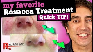 FACE FLUSHING TREATMENT  MY FAVORITE ROSACEA TREATMENT  Rosacea Cure [upl. by Button222]