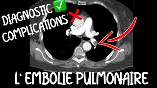 Radiologie  Lembolie pulmonaire pour lEDN  bases pour tout médecin [upl. by Clemence]