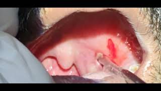 Peri tonsillar abscess Quinsy  Dr Hitesh Patel [upl. by Enilecram]