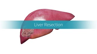 Liver Resection How and Why the Procedure Is Performed [upl. by Dasi]