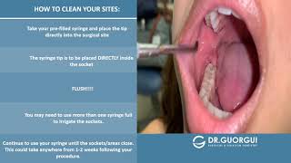 PostOperative Video Irrigation for Extraction and Wisdom Teeth [upl. by Ines]