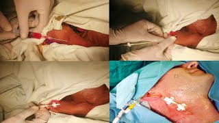 How to pass CVP line  Insertion of CVP Line in Emergency Operation Theater Victoria Hospital BWP [upl. by Lucey]