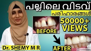 പല്ലിലെ വിടവ് മാറ്റാന്‍2022EngSubs GAP inbetween TEETH Malayalam DIASTEMA Closure Dr Shemy [upl. by Nelehyram]