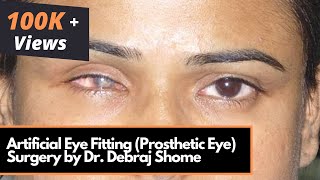 Artificial Eye Fitting Prosthetic Eye  Myoconjunctival Enucleation Surgery by DrDebraj Shome [upl. by Layman]