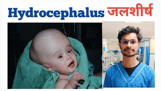 What is Hydrocephalus amp treatment hydrocephalus nursing mbbs medical norcet bscnursing gnm [upl. by Suckow]