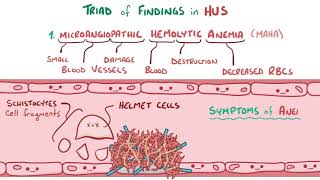 Hemolytic uremic syndrome [upl. by Lorine]