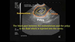 ENDOMETRIAL POLYP ON SONOHYSTEROGRAPHY  Ankoor Fertility Clinic Mumbai [upl. by Ardnossac559]