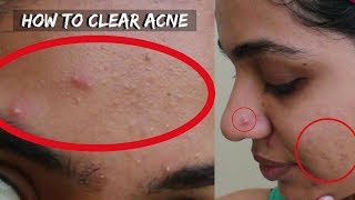 How to Get Rid of Pimples Acne  Marks in 3 Days  3 Home Remedies [upl. by Anisor]