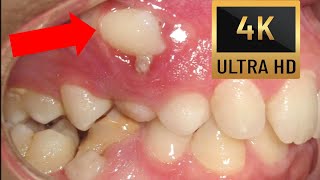 👀HOW BRACES WORK timelapse of Impacted Teeth in 4K Canine Impaction [upl. by Perl]