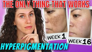 The ONLY Ingredients That Stop Hyperpigmentation And Reverse It [upl. by Alilad]