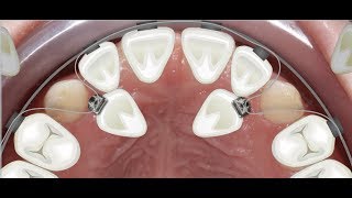 Orthodontic case report for palatally impacted canines traction [upl. by Narhet522]