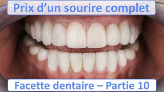 Prix Facette dentaire pour un sourire complet  Guide complet Facette dentaire  partie 10 [upl. by Zurc]