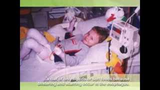 Epidermolysis Bullosa EB Awareness video extended [upl. by Adnaram]