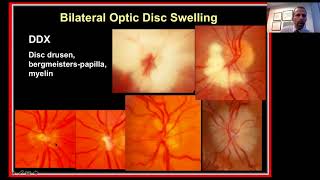 Approach to the Patient with Bilateral Optic Disc Swelling [upl. by Oirazan]