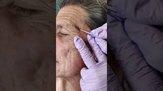 Acne extraction of blackheads and whiteheads popping pimples in Los Angeles [upl. by Normalie]