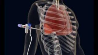 How to make a Thoracentesis pleural puncture with Pleurasafe [upl. by Itsrik446]