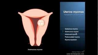 Uterine fibroids or myomas  Definition and symptoms [upl. by Seuqcaj]