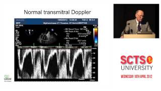 Diastolic dysfunction transoesophageal echocardiography [upl. by Gnirps580]