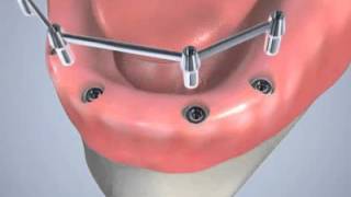 Prothèse dentaire sur implants [upl. by Odele]