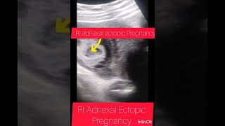 Ultrasound showing Ectopic PregnancyRt Adnexal Ectopic Pregnancyviralshortyoutubeshortsbabyuk [upl. by Stieglitz]