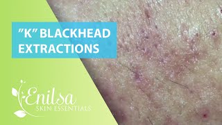 Blackheads Extractions “K’s” 7th Treatment [upl. by Bernj]