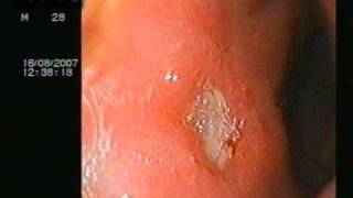 DUODENAL ULCER ON ENDOSCOPY [upl. by Eissej]