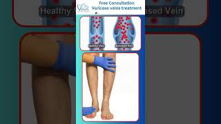 Varicose Vein Removal Phlebectomy Procedure By Best Vascular Surgeon telugu VaricoseVeins shorts [upl. by Llenwad]