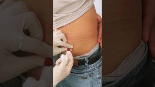 intramuscular injection injection into the gluteal muscle injection [upl. by Necyla]