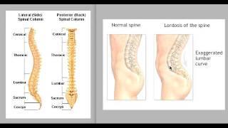 What is Lordosis Hyperlordosis [upl. by Elberfeld39]