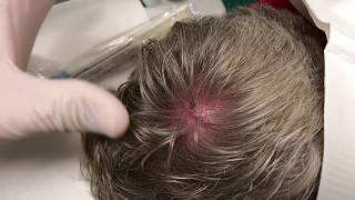 BIG Scalp Cyst or Spider Bite WHAT IS IT [upl. by Adnaval]