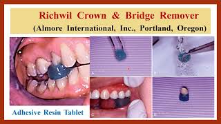 7 Richwil Crown amp Bridge Remover ازالة التركيبات بالقرص الصمغي اللاصق من ريتشويل [upl. by Ecinehs961]