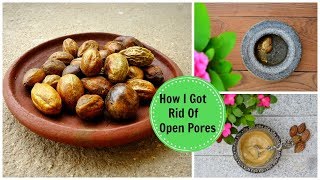 How I Got Rid Of Large OPEN PORES Permanently amp Naturally Using an Ayurvedic Remedy [upl. by Guidotti]