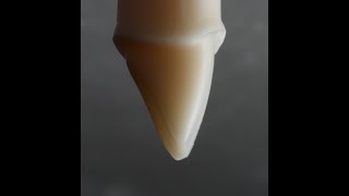 All Ceramic Crown Preparation for Emax and Zirconia [upl. by Marge]