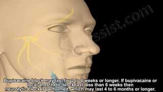 What is Trigeminal Neuralgia  Trigeminal Nerve Block Treatment [upl. by Nosac]