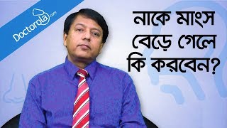 Hypertrophy nasal turbinates  নাকের মাংস বৃদ্ধি  নাকের মাংস বাড়লে করণীয়  Blocked nose relief [upl. by Odidnac]