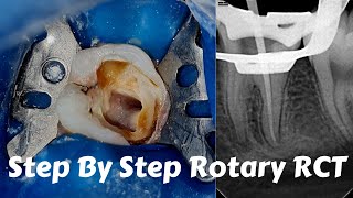 Live Steps Root Canal Rotary Protaper Endodontic Procedure ACP BMP obturation irrigation [upl. by Ataynek115]