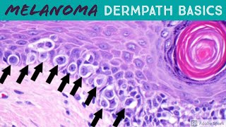 Melanoma vs Nevus Microscopic Clues for Malignancy Explained in 5 Minutes [upl. by Ailic]