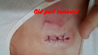 Bard Power Port Removal and New Power Port Implanted [upl. by Ahsir]