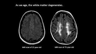 The Aging Brain  Week by Week Time Lapse [upl. by Kirkwood487]