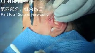 Preauricular Fistula Surgery（Part fourSuture the wound）耳前瘘管手术（第四部分：缝合伤口）20230815 [upl. by Nuy]