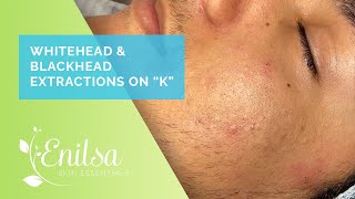 Enilsa is back Whitehead amp Blackhead Extractions on quotKquot  Part 1 [upl. by Crisey]